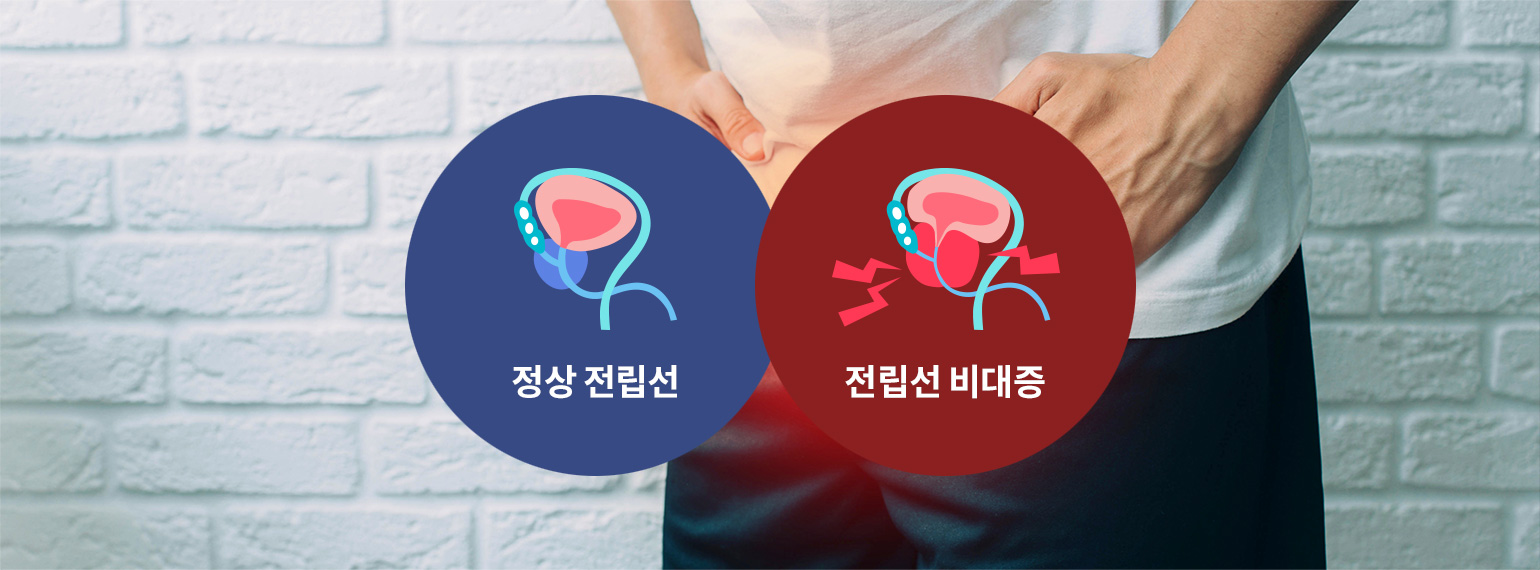 정상 전립선, 전립성 비대증