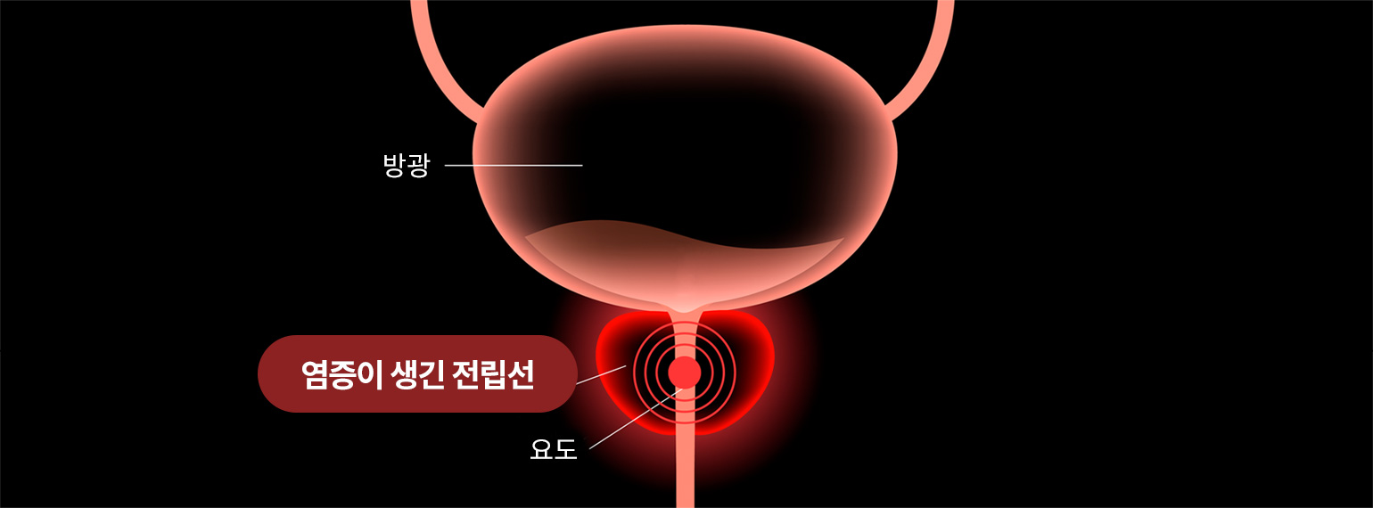 방광, 요도 이미지 - 염증이 생긴 전립선