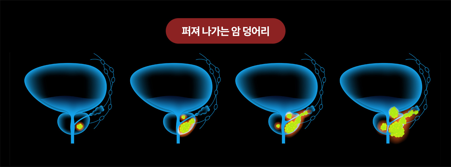 퍼져 나가는 암 덩어리
