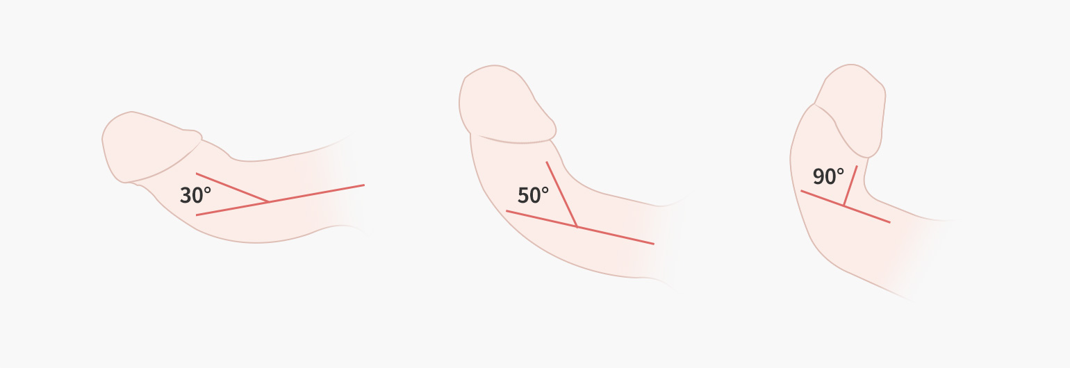 30도로 휜 음경 / 50도로 휜 음경 / 90도로 휜 음경